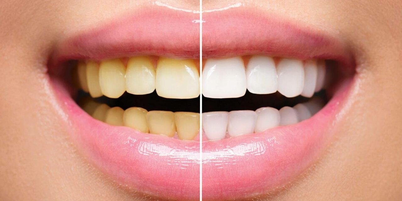 ಯಾವುದೆ ಖರ್ಚಿಲ್ಲದೆ ಹಳದಿಗಟ್ಟಿದ ಹಲ್ಲಿನಿಂದ ಪಡೆಯಿರಿ ಮುಕ್ತಿ